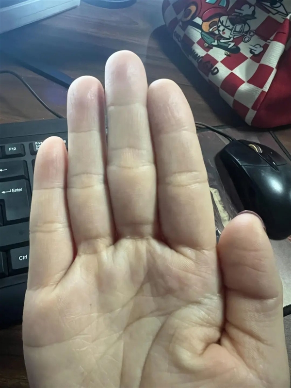 食指比無(wú)名指短 更容易精神病嗎